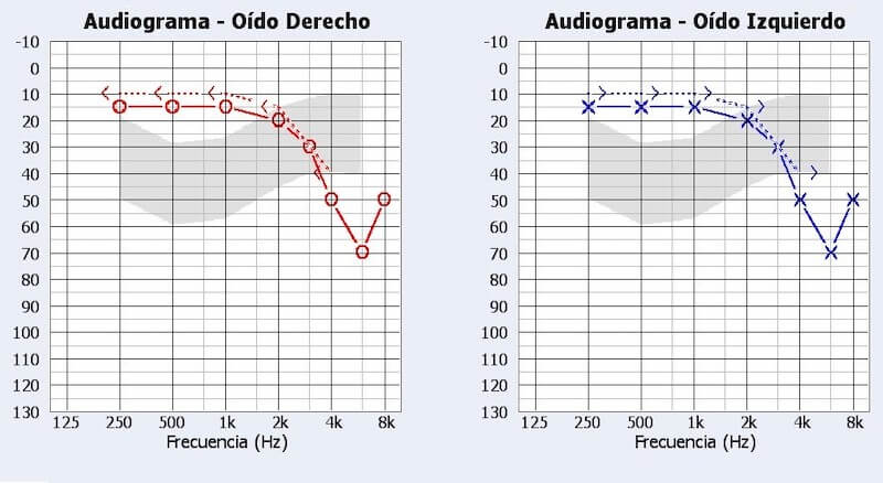 audiograma trauma acústico